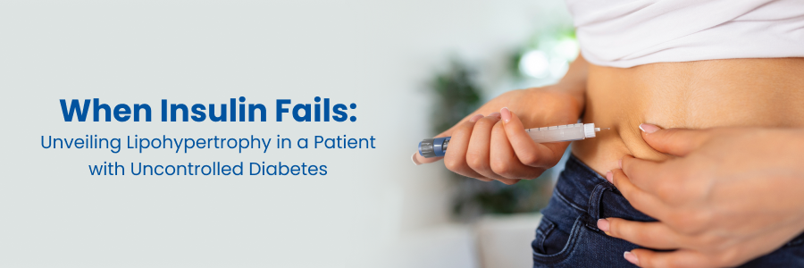 When insulin fail unveiling lipohypertrophy ina a patient with uncontrolled diabetes